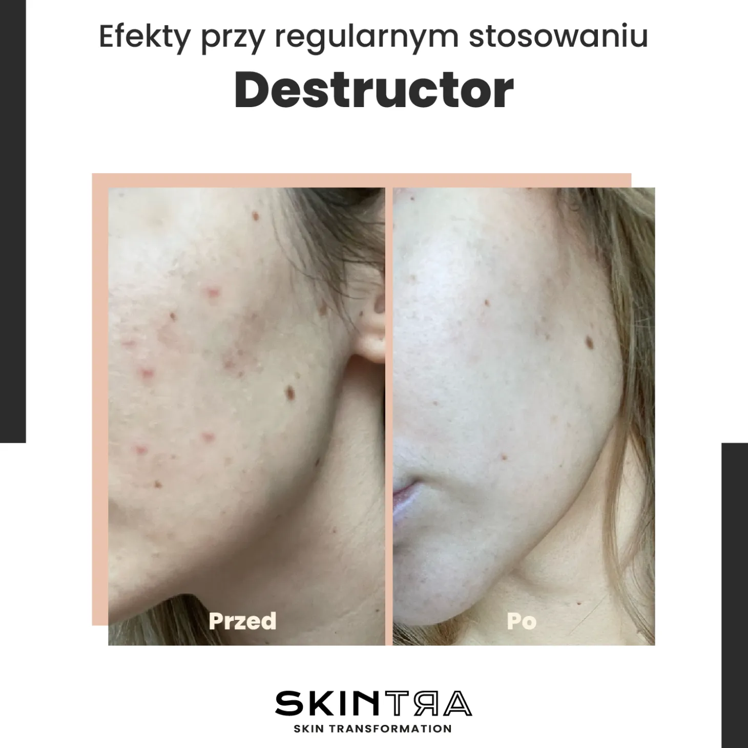SkinTra - Destructor - Całoroczny Peeling Kwasowy 24% - 100ml