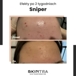 SkinTra - Sniper - Krem na Niedoskonałości - 20ml
